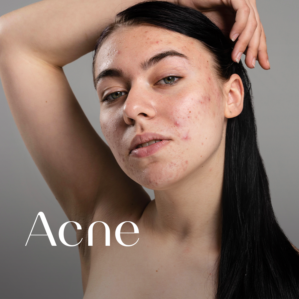 Acne